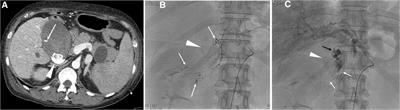 Transcatheter arterial embolization of cystic artery bleeding